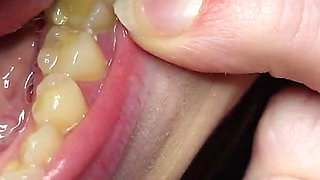 I Tell You About the Fillings in My Teeth and Dental Visits